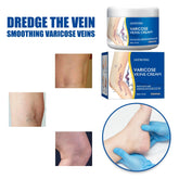 Veins Treatment Creams Soothing Painness Eliminate Vasculitis Phlebitis Remove Spider Leg Angiitis Improvement Ointment by Home for Health and Beauty