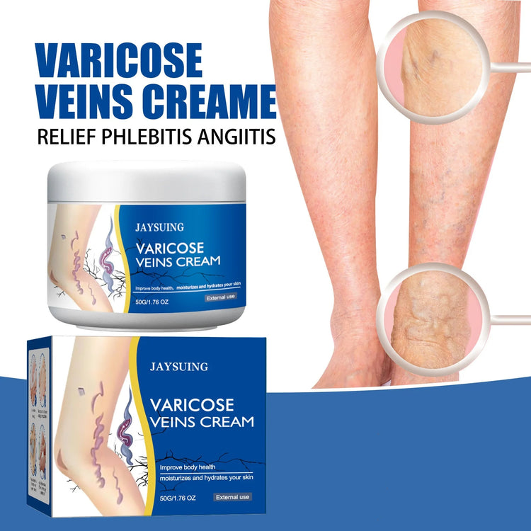 Veins Treatment Creams Soothing Painness Eliminate Vasculitis Phlebitis Remove Spider Leg Angiitis Improvement Ointment by Home for Health and Beauty