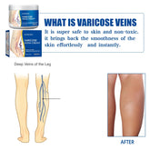 Veins Treatment Creams Soothing Painness Eliminate Vasculitis Phlebitis Remove Spider Leg Angiitis Improvement Ointment by Home for Health and Beauty