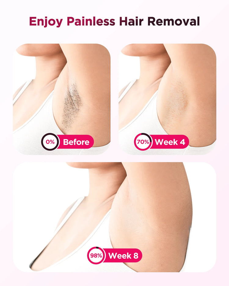 IPL Hair Removal Epilator Laser Permanent Painless Machine by Home for Health and Beauty
